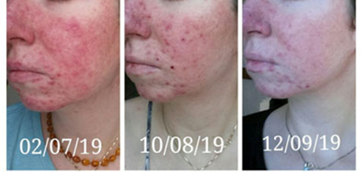 healy testimonial, healy testimonials, Healy, Acne, Hormonal Disorders, Testimonial, healy Comments, feedbak, user experience